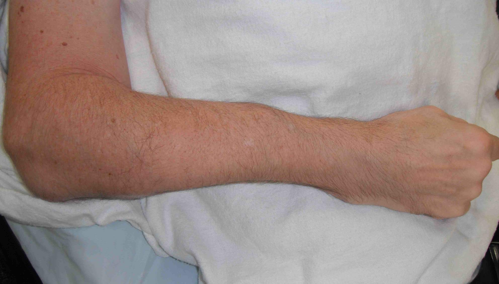 Osteogenesis Imperfecta Forearm